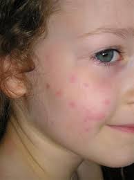 Urticaria (or hives) is a skin condition—commonly caused by an allergic reaction—that is characterized by raised red skin wheals (welts). Pin On Great Ideas Health Beauty Fashion
