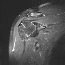 Image result for Shoulder MRI