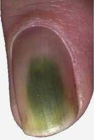 What is green nail syndrome and why isn't a fungal infection? Everything You Should Know About Green Nail Syndrome Green Nail Syndrome The Facts What Is Green Nail Fungus Cure Green Nail Syndrome Toenail Fungus Remedies