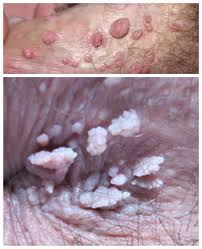 Image result for genital warts