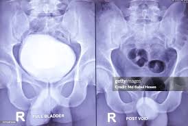 Image result for Retrograde Urethrogram