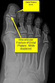 Maybe you would like to learn more about one of these? Foot Trauma Fracture Of The Interphalangeal Joint Of The Great Toe Best Podiatrist Nyc Lawrence Silverberg Dpm 20 E 46th St New York Ny 10017 The Best Bunion Surgery