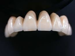Răng sứ Titan có tốt không? - Bệnh Viện Răng Hàm Mặt Sài Gòn