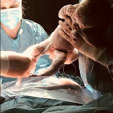 Wenn sonst keine komplikationen oder ähnliches vorliegen versucht man die babys so lange wie möglich im bauch zu halten, um anpassungsschwierigkeiten zu vermeiden. Alle Der Wie Lange Dauert Ein Kaiserschnitt Bei Zwillingen
