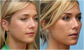 Rapid decrease in lung cancer and mela. Restylane Cheek Augmentation Facial Reshaping On The Same Sf 30y O Patient Anti Aging Skin Treatment Skin Treatment Diy Facial Contouring