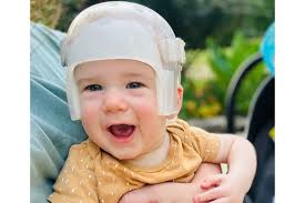 Fundraiser for Chynna Watson by Haley Clark : Myles' Surgery for Sagittal  Craniosynostosis