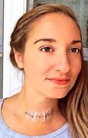 I Had My Thyroid Removed Here S How I Stay Healthy Now Thyroid Thyroid Surgery Thyroid Removal