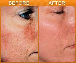 • tattoo removal, pigmentation and skin revitalization. Revlite Laser For Freckles And Brown Spots In Nj Soma Skin Laser