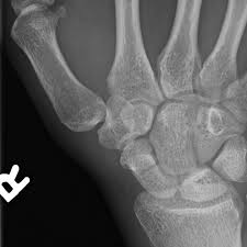 Image result for Fracture Complication