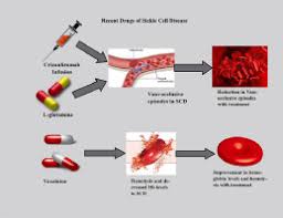 Sickle cell anemia is one of a group of inherited blood disorders marked by flawed hemoglobin, the protein molecule in red blood cells that carries oxygen from the lungs to the tissues in the body. Efficacy And Safety Of Recently Approved Drugs For Sickle Cell Disease A Review Of Clinical Trials Experimental Hematology