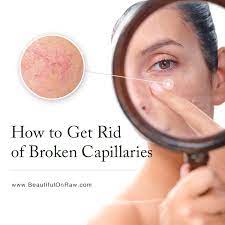 Akhavan, noting that if you have darker skin, neither can be safely used without possibly harming your face, so make sure to call ahead to check if your doctor has an nd:yag laser, which is the best option for darker skin tones. How To Get Rid Of Broken Capillaries Beautiful On Raw
