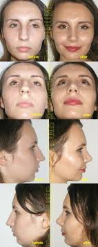 Cat costa o operatie de rinoplastie? Rinoplastie Septoplastie ClinicÄƒ ExclusivistÄƒ La Standarde Occidentale