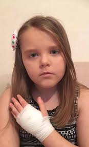 Second girl in hospital after suspected brown recluse spider bite left  oozing black hole in her hand