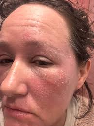 I haven't tried it myself but it might be worth a try if you're allergic.