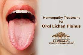 Homeopathy Treatment For Oral Lichen Planus Dr Mahavrat Patel