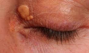 It is from broken blood vessels and i get them after i vomit extremely hard, though i suppose crying could do it to you as well. High Cholesterol Symptoms Lump Around Eyes Could Be Warning Sign Express Co Uk