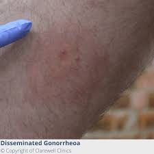 Image result for gonorrhea symptoms