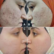 Topical timolol maleate 0.5% after fractional carbon dioxide laser versus  fractional carbon dioxide laser alone in treatment of acne scars: split  face comparative study