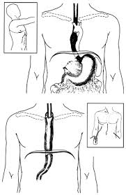 The incisions are made in the neck, chest and abdomen (belly) to remove the esophagus and rebuild the gastrointestinal tract. Mckeown Esophagectomy Three Field Approach Medicine Nurse Thoracic