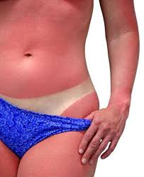 Image result for Sunburn