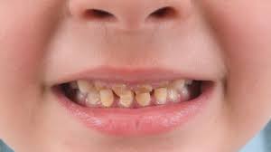 Metode / cara menjernihkan air yang kuning dan berbau besi. Penyebab Gigi Anak Kuning Dan Cara Mengatasinya