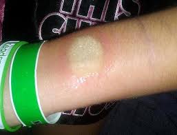 Maybe you would like to learn more about one of these? Cops Warn Of Resurgence Of Dangerous Ice And Salt Challenge Internet Craze That Sees Children Burn Themselves Using Household Items