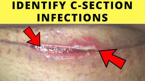 Yeast Infection Treatment After C Section Infections Fnsc Shulman Pro