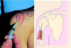 Image result for Biceps Tendon Injection