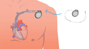 Icds and pacemakers are surgical implants made to help our heart have a regular rhythm. S Icd Vs Transveneous Icd And Pacemakers