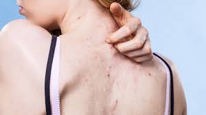 At the mild end, back acne can be treated with a benzoyl peroxide wash ( $15). Ask An Expert How Can I Get Rid Of Back Acne