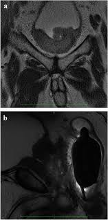 These include your blood pressure, heart rate and metab. Multiparametric Mri Local Staging Of Prostate Cancer Springerlink