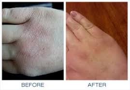 Tratament Eczema Gloves In A Bottle