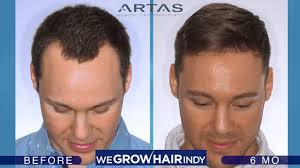 Sep 2018 evaluation before hair transplant operation: Hairline Hair Transplant Artas Robotic Fue 6 Months Post Procedure Youtube