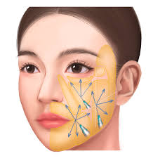 Low-Crosslinked Hyaluronic Acid Injections in the Superficial Fat Layer for  Facial Rejuvenation in Chinese Patients: A Retrospective Clinical Study