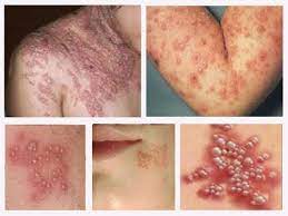 And has 0 komentar and has 0 komentar Salep Obat Gatal Eksim Basah Paling Ampuh Obat Gatal Alami Obat Gatal Ampuh Obat Gatal Apotik