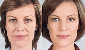 Advanced dermatology and aesthetics in new york city. Sculptra Aesthetic Treatment Nyc Top Ranked Zuckerman Plastic Surgery
