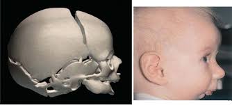 Pierre-Robinův syndrom, sekvence