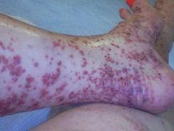 This inflammation causes the blood vessels in skin, intestine, joints as well as kidneys to leak. Iga Vasculitis Henoch Schonlein Purpura Vasculitis Uk