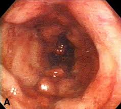Image result for Megacolon