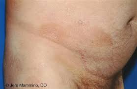They may appear as reddish or purple scaly areas. Mycosis Fungoides American Osteopathic College Of Dermatology Aocd