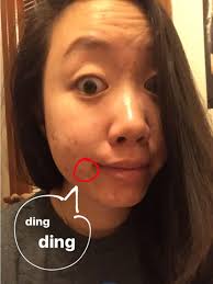 I Tried Apple Cider Vinegar For Acne To See If It Would Work