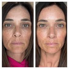 Jasmine's Self Microneedling and Priorities