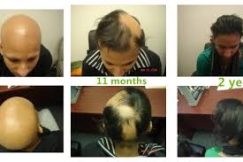 Acupuncture has proved to be as. Acupuncture Treatment Of Hair Loss Gastrointestinal Diseases Hemorrhoids Wrinkles Etc Tel 212 564 3324 é‡'ç‰Œèµ„è®¯ç½'