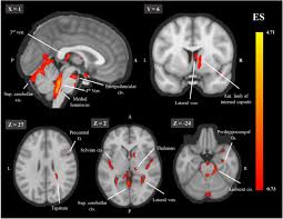 The map data is available for public download. From A Deep Learning Model Back To The Brain Inferring Morphological Markers And Their Relation To Aging Biorxiv