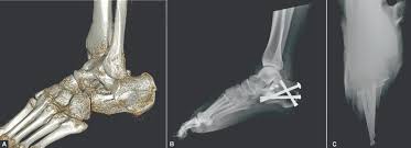 Image result for Calcaneus Compression Fracture