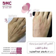 اخفي اثار الزمن من يديكـ بحقن الفيلر لدى دكتورة د رضوى عبدالمجيد عروض قوية على حقن الفيلر والبوتكس Omc
