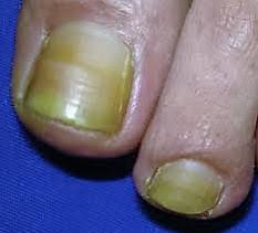 Image result for Yellow nail syndrome feet