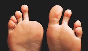 Image result for toe amputation