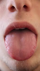 Image result for brown tongue symptoms