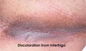 Image result for Intertrigo under breasts